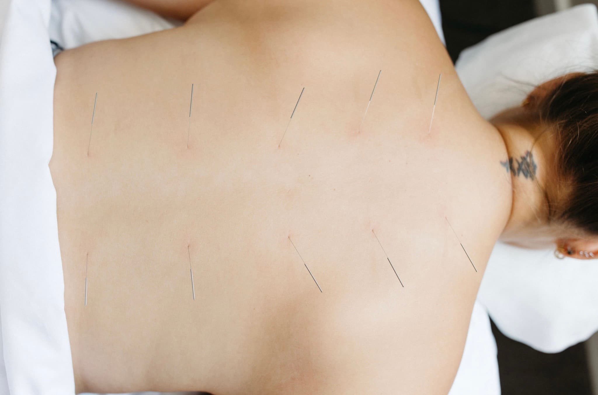 Acupuncture